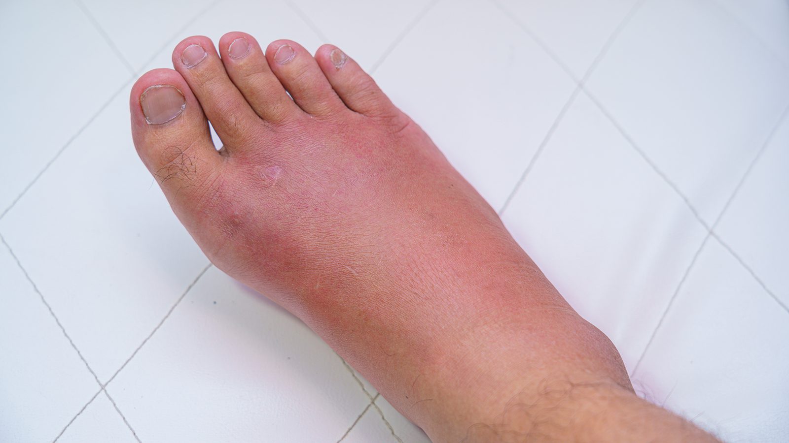 Harvard Physician Explains the 12 Things That Cause Swollen Feet |