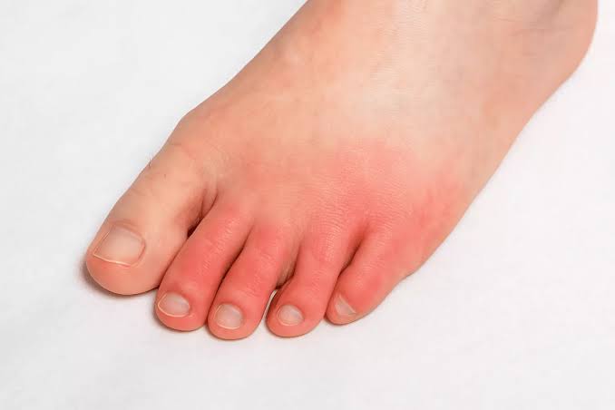 Swelling & Redness in Foot – Podiatry Care | Freedom Clinics Canary Wharf